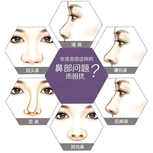 膨体隆鼻价格一般是多少？价格贵不贵？