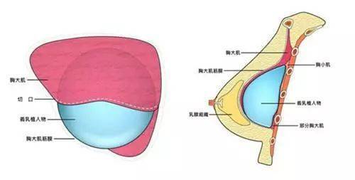 特贝茨隆胸价目表，真人体验隆胸效果反馈~