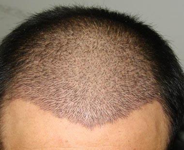 广州仁健植发靠谱吗？广州仁健植发怎么收费？